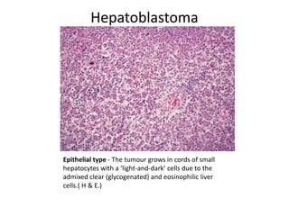 Hepatoblastoma
Epithelial type - The tumour grows in cords of small
hepatocytes with a ‘light-and-dark’ cells due to the
admixed clear (glycogenated) and eosinophilic liver
cells.( H & E.)
 