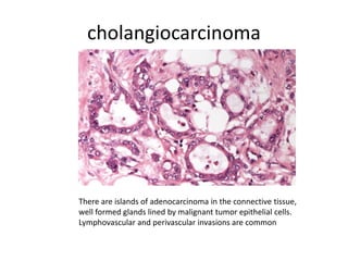 cholangiocarcinoma
There are islands of adenocarcinoma in the connective tissue,
well formed glands lined by malignant tumor epithelial cells.
Lymphovascular and perivascular invasions are common
 
