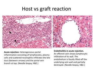 Host vs graft reaction
Acute rejection- Heterogeneous portal
inflammation consisting of lymphocytes, plasma
cells and scattered neutrophils infiltrates the bile
duct (between arrows) and the portal vein
branch at top. (Needle biopsy, H&E.)
Endotheliitis in acute rejection.
An efferent vein shows lymphocytic
infiltration of its wall. The
endothelium is focally lifted off the
underlying vein wall and partially
destroyed. (Needle biopsy, H&E.)
 