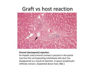 Graft vs host reaction
Chronic (ductopenic) rejection.
An hepatic artery branch (arrow) is present in the portal
tract but the corresponding interlobular bile duct has
disappeared as a result of rejection. A sparse lymphocytic
infiltrate remains. (Explanted donor liver, H&E.)
 