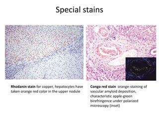 Special stains
Rhodanin stain for copper, hepatocytes have
taken orange red color in the upper nodule
Congo red stain orange-staining of
vascular amyloid deposition,
characteristic apple-green
birefringence under polarized
microscopy (inset)
 