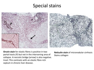 Special stains
Orcein stain for elastic fibres is positive in two
portal tracts (P) but not in the intervening area of
collapse. A necrotic bridge (arrow) is also negative.
Inset: This contrasts with an elastic fibre-rich
septum in chronic liver disease.
P
P
Reticulin stain of micronodular cirrhosis
Stains collagen
 