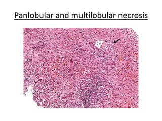 Panlobular and multilobular necrosis
 