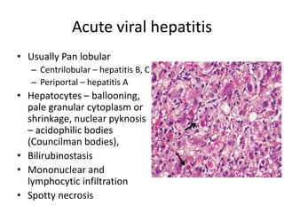 Acute viral hepatitis
• Usually Pan lobular
– Centrilobular – hepatitis B, C
– Periportal – hepatitis A
• Hepatocytes – ballooning,
pale granular cytoplasm or
shrinkage, nuclear pyknosis
– acidophilic bodies
(Councilman bodies),
• Bilirubinostasis
• Mononuclear and
lymphocytic infiltration
• Spotty necrosis
 