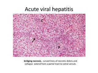 Acute viral hepatitis
bridging necrosis. curved lines of necrotic debris and
collapse extend from a portal tract to cetral venule.
C
P
 