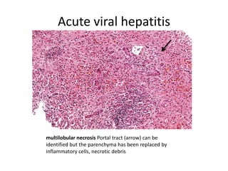 Acute viral hepatitis
multilobular necrosis Portal tract (arrow) can be
identified but the parenchyma has been replaced by
inflammatory cells, necrotic debris
 
