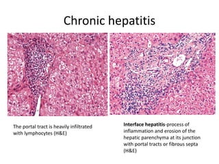 Chronic hepatitis
The portal tract is heavily infiltrated
with lymphocytes (H&E)
Interface hepatitis-process of
inflammation and erosion of the
hepatic parenchyma at its junction
with portal tracts or fibrous septa
(H&E)
 
