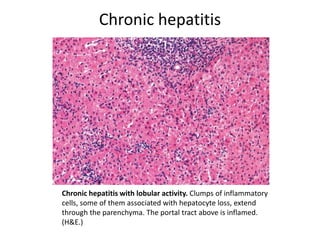 Chronic hepatitis
Chronic hepatitis with lobular activity. Clumps of inflammatory
cells, some of them associated with hepatocyte loss, extend
through the parenchyma. The portal tract above is inflamed.
(H&E.)
 