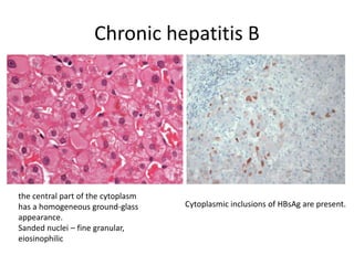 Chronic hepatitis B
the central part of the cytoplasm
has a homogeneous ground-glass
appearance.
Sanded nuclei – fine granular,
eiosinophilic
Cytoplasmic inclusions of HBsAg are present.
 