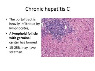 Chronic hepatitis C
• The portal tract is
heavily infiltrated by
lymphocytes,
• A lymphoid follicle
with germinal
center has formed
• 15-25% may have
steatosis
 
