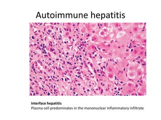 Autoimmune hepatitis
Interface hepatitis
Plasma cell predominates in the mononuclear inflammatory infiltrate
 