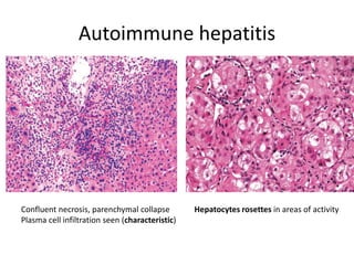 Autoimmune hepatitis
Hepatocytes rosettes in areas of activityConfluent necrosis, parenchymal collapse
Plasma cell infiltration seen (characteristic)
 