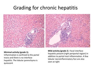 Grading for chronic hepatitis
Minimal activity (grade 1).
Inflammation is confined to the portal
tracts and there is no interface
hepatitis. The lobular parenchyma is
quiescent
Mild activity (grade 2). Focal interface
hepatitis present (right periportal region) in
addition to portal tract inflammation. A few
lobular necroinflammatory foci are also
seen at right
 