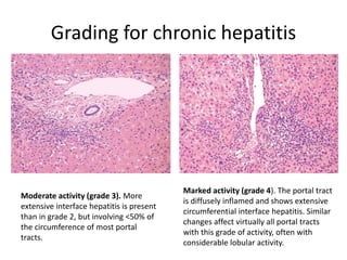 Grading for chronic hepatitis
Moderate activity (grade 3). More
extensive interface hepatitis is present
than in grade 2, but involving <50% of
the circumference of most portal
tracts.
Marked activity (grade 4). The portal tract
is diffusely inflamed and shows extensive
circumferential interface hepatitis. Similar
changes affect virtually all portal tracts
with this grade of activity, often with
considerable lobular activity.
 