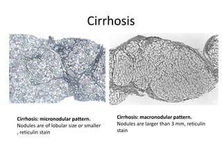 Cirrhosis
Cirrhosis: micronodular pattern.
Nodules are of lobular size or smaller
, reticulin stain
Cirrhosis: macronodular pattern.
Nodules are larger than 3 mm, reticulin
stain
 