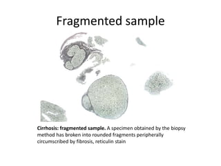 Fragmented sample
Cirrhosis: fragmented sample. A specimen obtained by the biopsy
method has broken into rounded fragments peripherally
circumscribed by fibrosis, reticulin stain
 