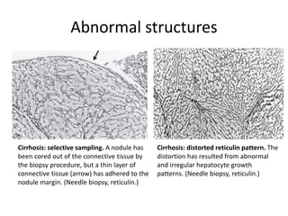 Abnormal structures
Cirrhosis: selective sampling. A nodule has
been cored out of the connective tissue by
the biopsy procedure, but a thin layer of
connective tissue (arrow) has adhered to the
nodule margin. (Needle biopsy, reticulin.)
Cirrhosis: distorted reticulin pattern. The
distortion has resulted from abnormal
and irregular hepatocyte growth
patterns. (Needle biopsy, reticulin.)
 