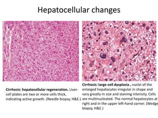 Hepatocellular changes
Cirrhosis: hepatocellular regeneration. Liver-
cell plates are two or more cells thick,
indicating active growth. (Needle biopsy, H&E.)
Cirrhosis: large-cell dysplasia , nuclei of the
enlarged hepatocytes irregular in shape and
vary greatly in size and staining intensity. Cells
are multinucleated. The normal hepatocytes at
right and in the upper left-hand corner. (Wedge
biopsy, H&E.)
 