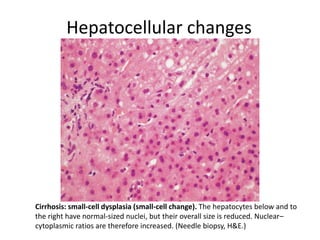 Hepatocellular changes
Cirrhosis: small-cell dysplasia (small-cell change). The hepatocytes below and to
the right have normal-sized nuclei, but their overall size is reduced. Nuclear–
cytoplasmic ratios are therefore increased. (Needle biopsy, H&E.)
 