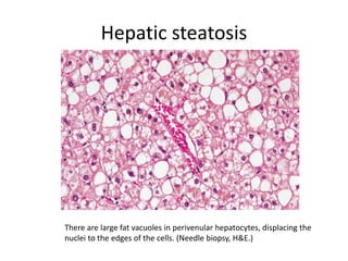 Hepatic steatosis
There are large fat vacuoles in perivenular hepatocytes, displacing the
nuclei to the edges of the cells. (Needle biopsy, H&E.)
 