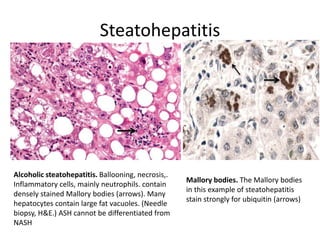 Steatohepatitis
Alcoholic steatohepatitis. Ballooning, necrosis,.
Inflammatory cells, mainly neutrophils. contain
densely stained Mallory bodies (arrows). Many
hepatocytes contain large fat vacuoles. (Needle
biopsy, H&E.) ASH cannot be differentiated from
NASH
Mallory bodies. The Mallory bodies
in this example of steatohepatitis
stain strongly for ubiquitin (arrows)
 