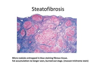 Steatofibrosis
Micro nodules entrapped in blue-staining fibrous tissue.
Fat accumulation no longer seen, burned out stage. (masson trichrome stain)
 
