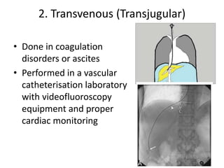2. Transvenous (Transjugular)
• Done in coagulation
disorders or ascites
• Performed in a vascular
catheterisation laboratory
with videofluoroscopy
equipment and proper
cardiac monitoring
 