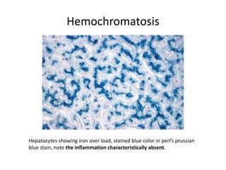 Hemochromatosis
Hepatocytes showing iron over load, stained blue color in perl’s prussian
blue stain, note the inflammation characteristically absent.
 