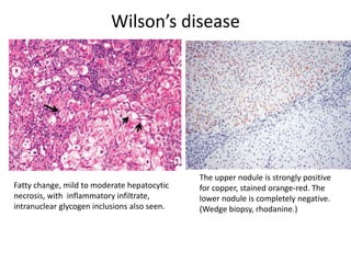 Wilson’s disease
Fatty change, mild to moderate hepatocytic
necrosis, with inflammatory infiltrate,
intranuclear glycogen inclusions also seen.
The upper nodule is strongly positive
for copper, stained orange-red. The
lower nodule is completely negative.
(Wedge biopsy, rhodanine.)
 
