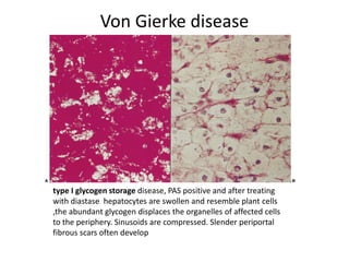 Von Gierke disease
type I glycogen storage disease, PAS positive and after treating
with diastase hepatocytes are swollen and resemble plant cells
,the abundant glycogen displaces the organelles of affected cells
to the periphery. Sinusoids are compressed. Slender periportal
fibrous scars often develop
 