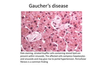 Gaucher’s disease
Pale-staining, striated Kupffer cells containing stored lipid are
present within sinusoids. The affected cells compress hepatocytes
and sinusoids and may give rise to portal hypertension. Pericellular
fibrosis is a common finding
 
