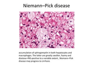 Niemann–Pick disease
accumulation of sphingomyelin in both hepatocytes and
macrophages. The latter are greatly swollen, foamy and
diastase–PAS-positive to a variable extent , Niemann–Pick
disease may progress to cirrhosis
 