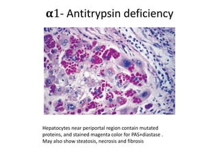 𝛂1- Antitrypsin deficiency
Hepatocytes near periportal region contain mutated
proteins, and stained magenta color for PAS+diastase .
May also show steatosis, necrosis and fibrosis
 