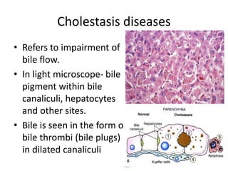 Cholestasis diseases
• Refers to impairment of
bile flow.
• In light microscope- bile
pigment within bile
canaliculi, hepatocytes
and other sites.
• Bile is seen in the form of
bile thrombi (bile plugs)
in dilated canaliculi
 