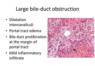 Large bile-duct obstruction
• Dilatation
intercanaliculi
• Portal tract edema
• Bile duct proliferation
at the margin of
portal tract
• Mild inflammatory
infiltrate
 