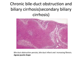 Chronic bile-duct obstruction and
biliary cirrhosis(secondary biliary
cirrhosis)
Bile duct obstruction persists, bile duct infarct and increasing fibrosis.
Jigsaw puzzle shape
 