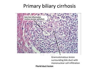 Primary biliary cirrhosis
Grannulomatous lesion
surrounding bile duct with
mononuclear cell infiltration
Florid duct lesion
 