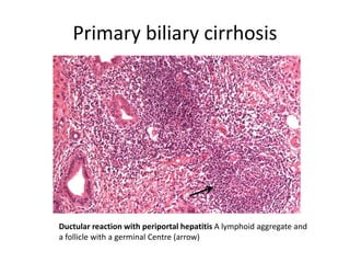 Primary biliary cirrhosis
Ductular reaction with periportal hepatitis A lymphoid aggregate and
a follicle with a germinal Centre (arrow)
 