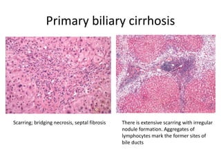 Primary biliary cirrhosis
Scarring; bridging necrosis, septal fibrosis There is extensive scarring with irregular
nodule formation. Aggregates of
lymphocytes mark the former sites of
bile ducts
 