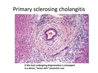 Primary sclerosing cholangitis
A bile duct undergoing degeneration is entrapped
in a dense, “onion-skin” concentric scar
 