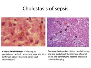 Cholestasis of sepsis
Canalicular cholestasis – bile plug at
centilobular canliculi , sometime associate with
kuffer cell activity and mild poratl tract
inflammation
Ductular cholestasis – dilated canal of hering
and bile ductules at the interface of portal
tracts and parenchyma become dilate and
contains bile plug
 