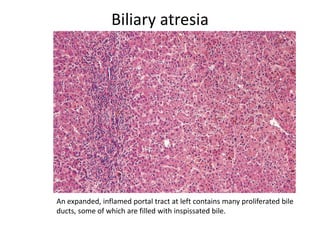 Biliary atresia
An expanded, inflamed portal tract at left contains many proliferated bile
ducts, some of which are filled with inspissated bile.
 