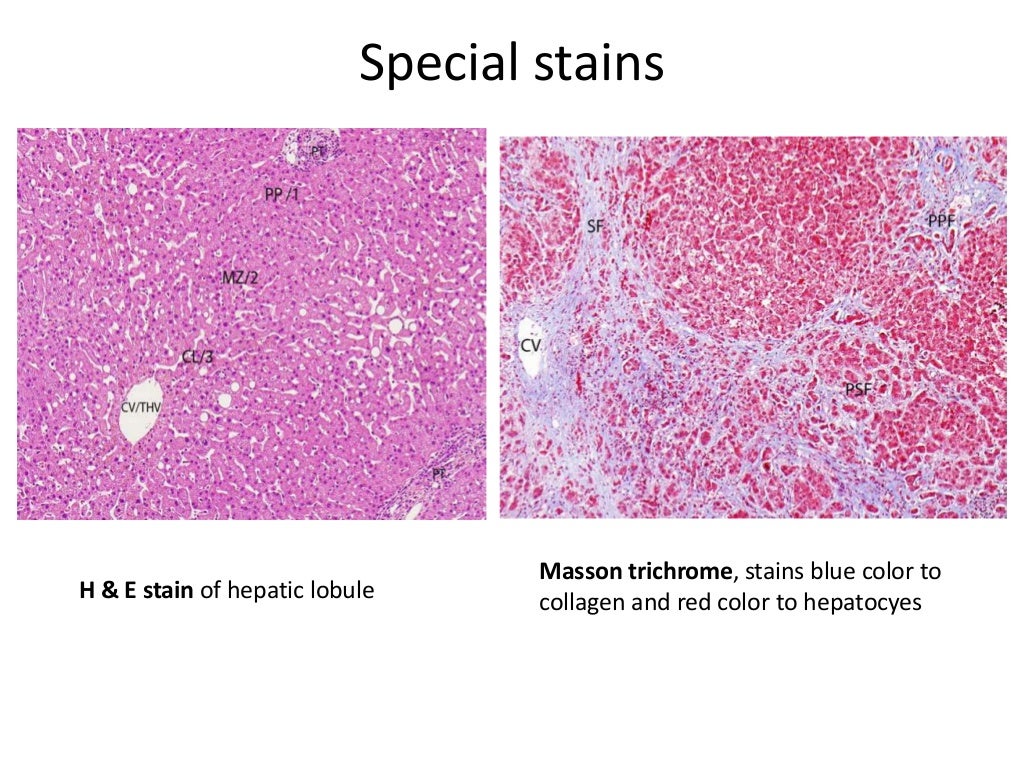 Liver biopsy interpretation