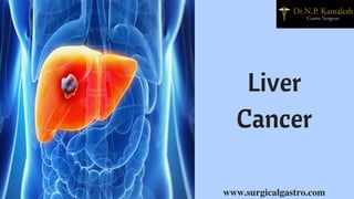 Liver
Cancer
www.surgicalgastro.com
 