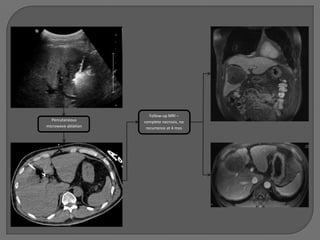 Follow-up MRI –
  Percutaneous       complete necrosis, no
microwave ablation    recurrence at 4 mos
 