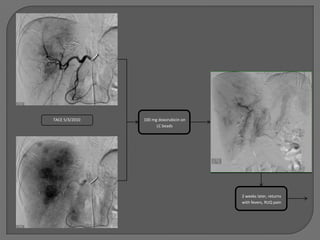 TACE 5/3/2010   100 mg doxorubicin on
                      LC beads




                                        2 weeks later, returns
                                        with fevers, RUQ pain
 
