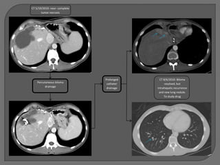 CT 5/19/2010: near- complete
       tumor necrosis




                               Prolonged     CT 8/6/2010: Biloma
    Percutaneous biloma         catheter         resolved, but
          drainage              drainage   intrahepatic recurrence
                                            and new lung nodule.
                                                To study drug
 