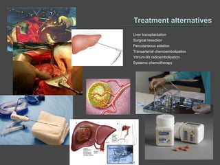 Liver transplantation
Surgical resection
Percutaneous ablation
Transarterial chemoembolization
Yttrium-90 radioembolization
Systemic chemotherapy
 