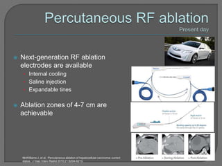    Next-generation RF ablation
    electrodes are available
    • Internal cooling
    • Saline injection
    • Expandable tines


   Ablation zones of 4-7 cm are
    achievable




    McWilliams J, et al. Percutaneous ablation of hepatocellular carcinoma: current
    status. J Vasc Interv Radiol 2010;21:S204-S213.
 