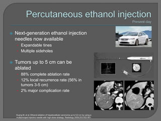    Next-generation ethanol injection
    needles now available
    • Expandable tines
    • Multiple sideholes


   Tumors up to 5 cm can be
    ablated
    • 88% complete ablation rate
    • 12% local recurrence rate (56% in
      tumors 3-5 cm)
    • 2% major complication rate




    Kuang M, et al. Ethanol ablation of hepatocellular carcinoma up to 5.0 cm by using a
    multipronged injectino needle with high-dose strategy. Radiology 2009;253:552-561.
 